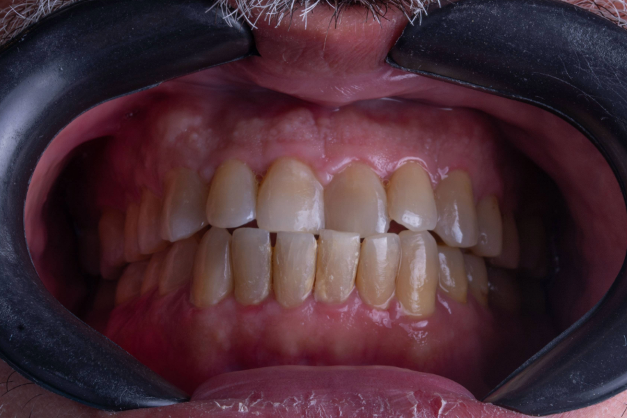 قبل تغير لون و شكل الأسنان لإعادة تأهيل الابتسامة.